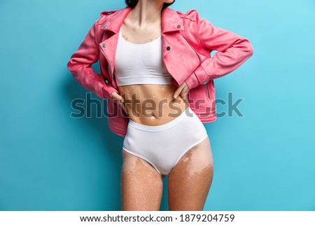 Faceless woman with violtion of skin pigmentation demonstrates perfect figure dressed in white bra and panties accepts herself as she is