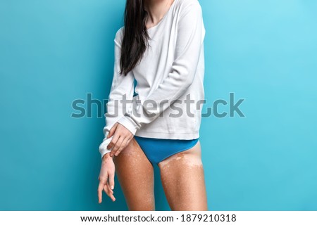 Young brunette woman enjoys her unusual beauty has vitiligo skin disorder on legs wears white jumper and panties isolated over blue background
