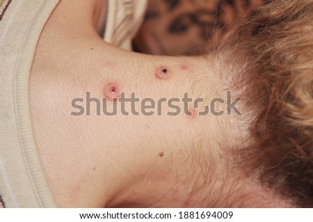 Leeches bite marks on the neck after medicinal leech therapy, leech cure, hirudotherapy for the treatment of venous congestion. Royalty-Free Stock Photo #1881694009