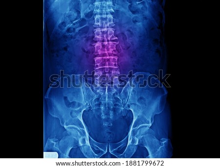 A radiograph of lumbar spine and pelvis showing normal bones and joints without sign of osteoarthritis, spondylosis or infection. The patient had low back pain and hip pain.
