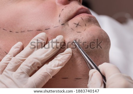 Man beauty procedure beard hair implant for senior man Royalty-Free Stock Photo #1883740147