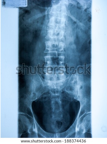 X ray MRI - Image of Spine pain and Hip bone