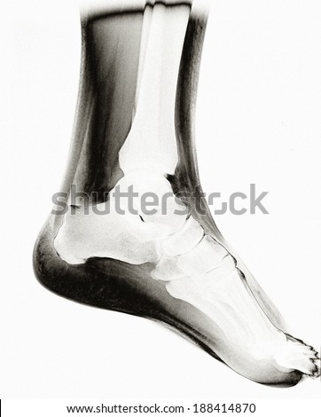 Left foot MRI - X-ray resonance - Medical Image