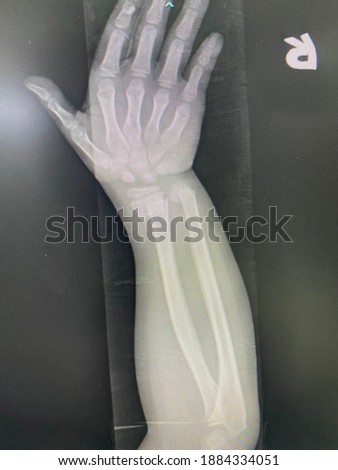 The picture of flim x-ray right hand  of patient who have distal end radius fracture,Medical Technology and Science concept.