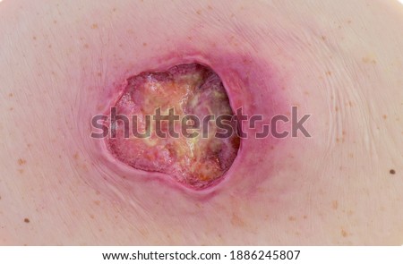 pressure ulcer undermining with pocket formation Royalty-Free Stock Photo #1886245807