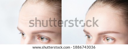 Forehead wrinkles before and after mefotherapy injection, treatment, surgery. Womans face close up. Royalty-Free Stock Photo #1886743036