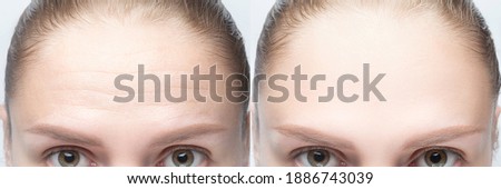 Forehead wrinkles before and after injection, treatment, surgery. Womans face close up. Royalty-Free Stock Photo #1886743039