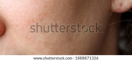 Problematic female facial skin close-up. Skin peeling, acne, adolescence. Peeling of the skin in the cold. Royalty-Free Stock Photo #1888871326
