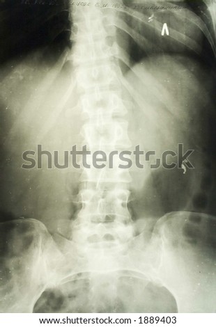 x-ray picture of the trunk