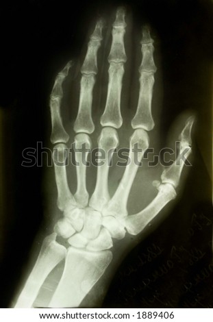 x-ray picture of the palm