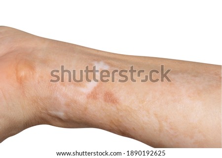 Scars on the arms. Caused by an accident, hot oil splashed onto the arm area.