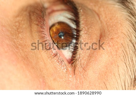 Cone-shaped deformity of the cornea. Macro brown male eye. End stage of keratoconus