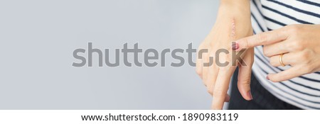 Banner close up: First degree heat burn scar on a woman's hand. The wound damage on epidermis outermost layer of skin. Healing, Removal, Treatment, Accident in the kitchen, Scar, Scald, Wound Healing Royalty-Free Stock Photo #1890983119