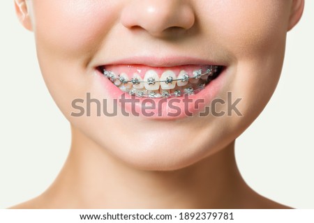 Orthodontic Treatment. Dental Care Concept. Beautiful Woman Healthy Smile close up. Closeup Ceramic and Metal Brackets on Teeth. Beautiful Female Smile with Braces Royalty-Free Stock Photo #1892379781