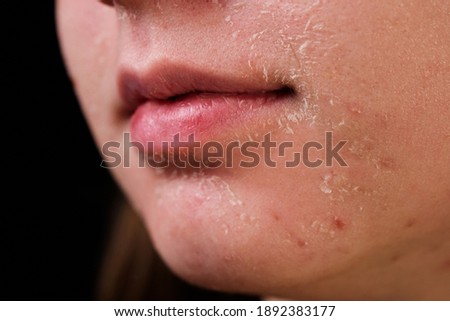 flaky skin of a girl after cosmetic procedures Royalty-Free Stock Photo #1892383177