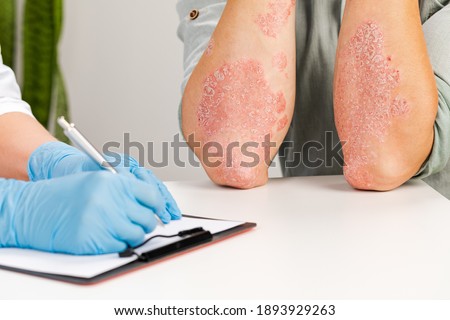 A gloved dermatologist examines the skin of a sick patient and records observations. Examination and diagnosis of skin diseases-allergies, psoriasis, eczema, dermatitis. Royalty-Free Stock Photo #1893929263