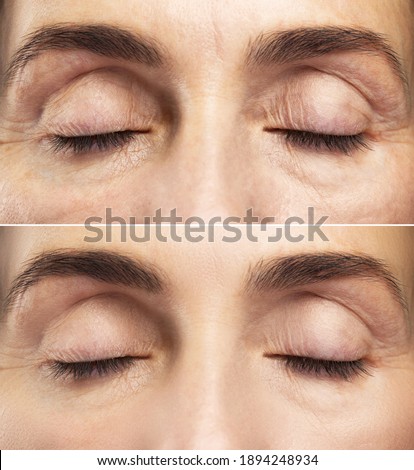 Anti aging treatment.  Comparison of female eyes before and after rejuvenation.