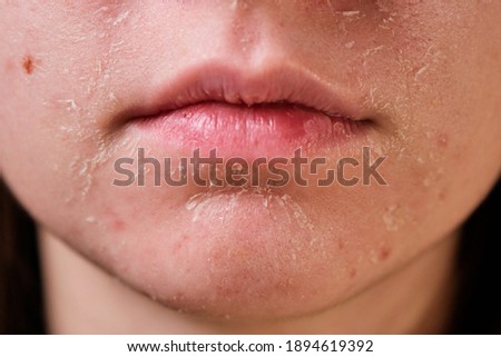 flaky skin of a girl after cosmetic procedures Royalty-Free Stock Photo #1894619392