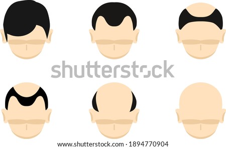 set illustration of Androgenetic alopecia   man's head