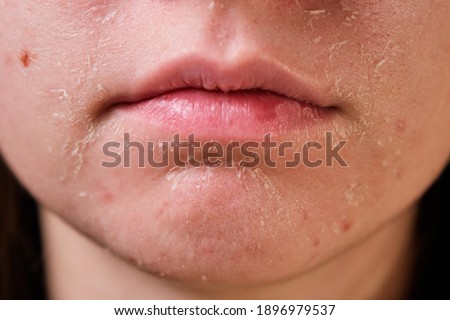 flaky skin of a girl after cosmetic procedures Royalty-Free Stock Photo #1896979537