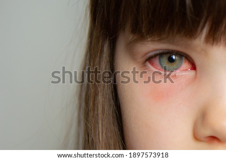 Pink eye Conjunctivitis in a girl's eye Royalty-Free Stock Photo #1897573918