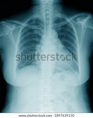 high qaulity chest x-ray image in blue tone black background, lung infection with secretion 