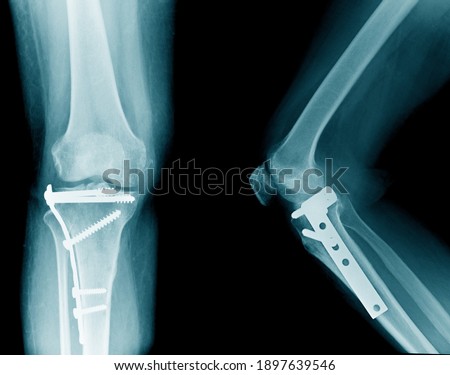 x-ray image of knee, tibia fracture with post operation internal fixation  Royalty-Free Stock Photo #1897639546