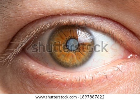 Macro photos of the human eye - cataract clouding of the lens, deterioration of vision. Cataract treatment, surgery and ophthalmology Royalty-Free Stock Photo #1897887622