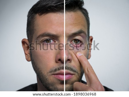 Man face divided into two parts one fresh and one with hangover. Before party and after party. Alcohol harm. Bad habits vs good habits. Alcoholism concept. Healthy lifestyle vs unhealthy lifestyle.