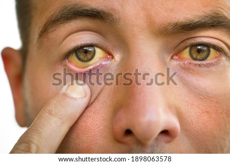 Liver disease. Young man face with yellowish eyes and skin. Sign of problems with liver. Symptoms of high bilirubin, jaundice, hepatosis, hepatitis, cirrhosis, liver failure Royalty-Free Stock Photo #1898063578