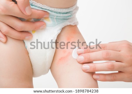 Young adult mother hand applying white medical ointment on toddler leg. Red rash on skin from diaper. Care about baby body. Closeup. Front view. Isolated on light gray background. Royalty-Free Stock Photo #1898784238