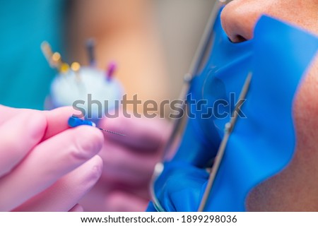 Endodontic Root Canal Treatment Process  Royalty-Free Stock Photo #1899298036