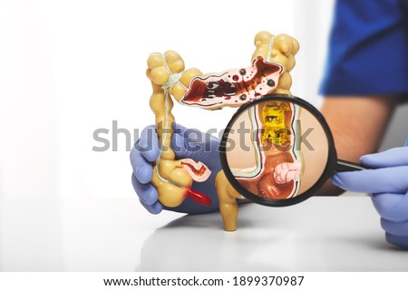 Colon model with different diseases in doctors hands. Colon tumor enlarged in a magnifying glass Royalty-Free Stock Photo #1899370987