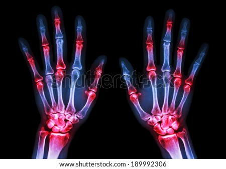 film x-ray both human's hands and arthritis at multiple joint (Gout,Rheumatoid) Royalty-Free Stock Photo #189992306