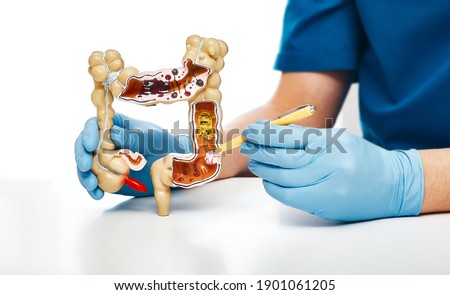 Cancer intestines. Gastroenterologist pointing pen tumor colon using an anatomical model for medical education Royalty-Free Stock Photo #1901061205