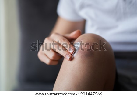 Close up of a person rubbing cream for healing injured knee joint. Bruise on the knee. Leg pain. Royalty-Free Stock Photo #1901447566