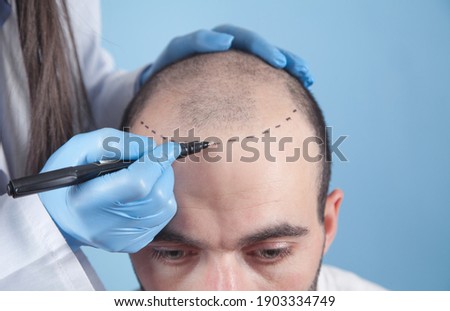 Patient suffering from hair loss in consultation with a doctor. Doctor using skin marker Royalty-Free Stock Photo #1903334749