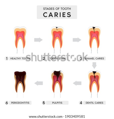 Tooth caries structure and Progression and Treatment: Dental Illustration. In realistic style. Stain, enamel caries, dentil, pulpitis, periodontitis. Vector illustration 3d.