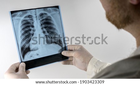 Lungs of a healthy person in the picture, an x-ray of a person's lungs in the hands of a doctor, a medical worker analyzes an x-ray, pneumonia.