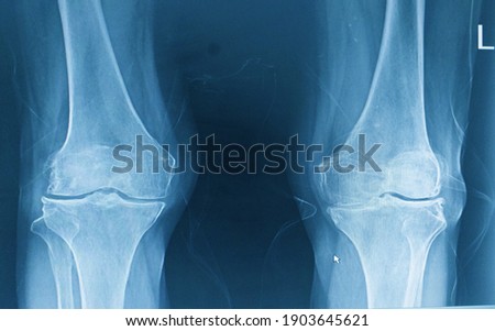 Knee joint x-ray a female 67 year old showing narrowing joint spaces,bilaterally.Sclerosis of articular surface of lateral tibial plateau and lateral femoral condyles,OA both knees. Royalty-Free Stock Photo #1903645621