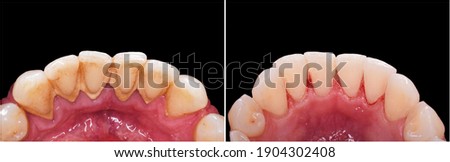 teeth cleaning and whitening before and after picture Royalty-Free Stock Photo #1904302408