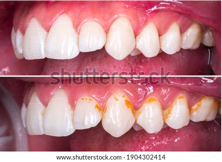 teeth cleaning and whitening before and after picture Royalty-Free Stock Photo #1904302414
