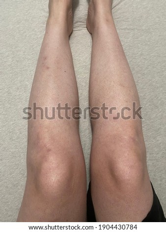 Keratosis Pilaris, a skin problem, on a woman's legs. Also known as strawberry legs. KP Royalty-Free Stock Photo #1904430784