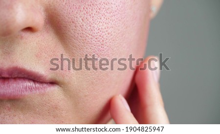Macro skin with enlarged pores. Allergic reaction, peeling, care for problem skin. Royalty-Free Stock Photo #1904825947