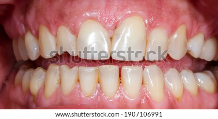 beautiful smile by press ceramic crown and venners 