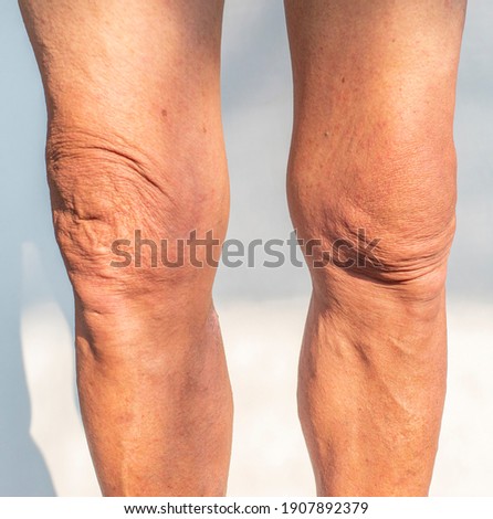 Legs and knees picture of an elderly person with health problems Royalty-Free Stock Photo #1907892379