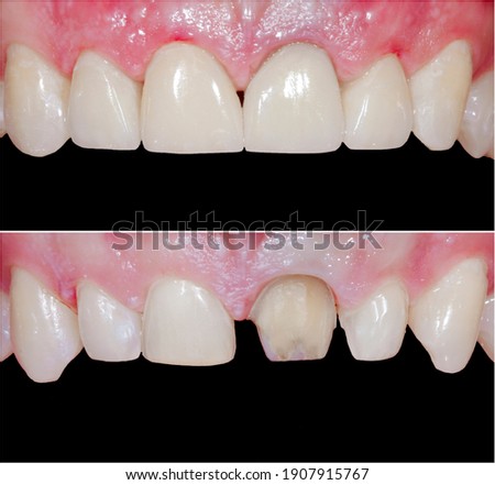 teeth reshaping with press ceramic crwons and venners