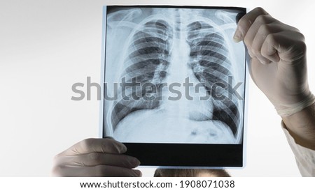 A medical professional holds an X-ray of the lungs, a doctor examines pneumonia, a respiratory disease. Pulmonary complication. Royalty-Free Stock Photo #1908071038