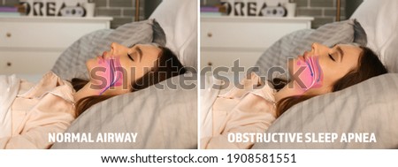 Illustrations showing difference between normal breathing and obstructive sleep apnea Royalty-Free Stock Photo #1908581551