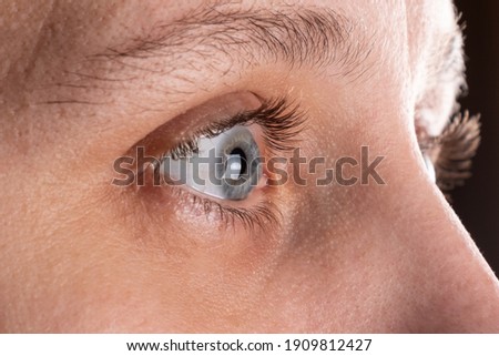 woman eye with corneal dystrophy, keratoconus, thinning of the cornea. Royalty-Free Stock Photo #1909812427